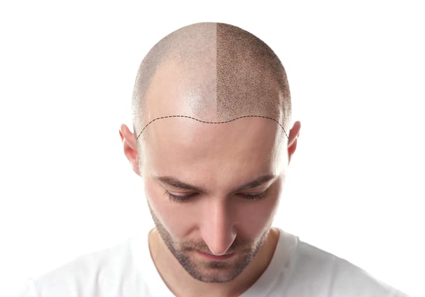 micropigmentation