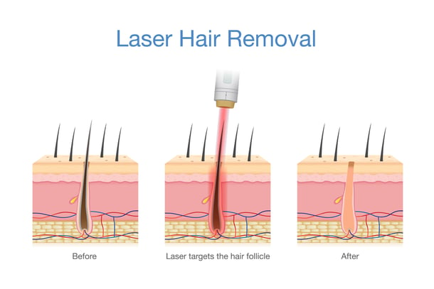 laser hair removal