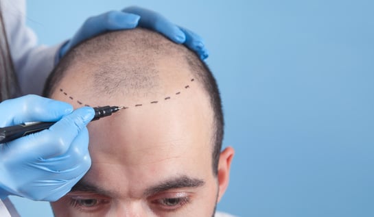 micro scalp pigmentation